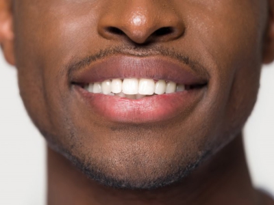 Why Dental Veneers in Colombia Are a Smart Choice for Americans